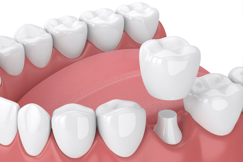 Dental Crowns in Boerne