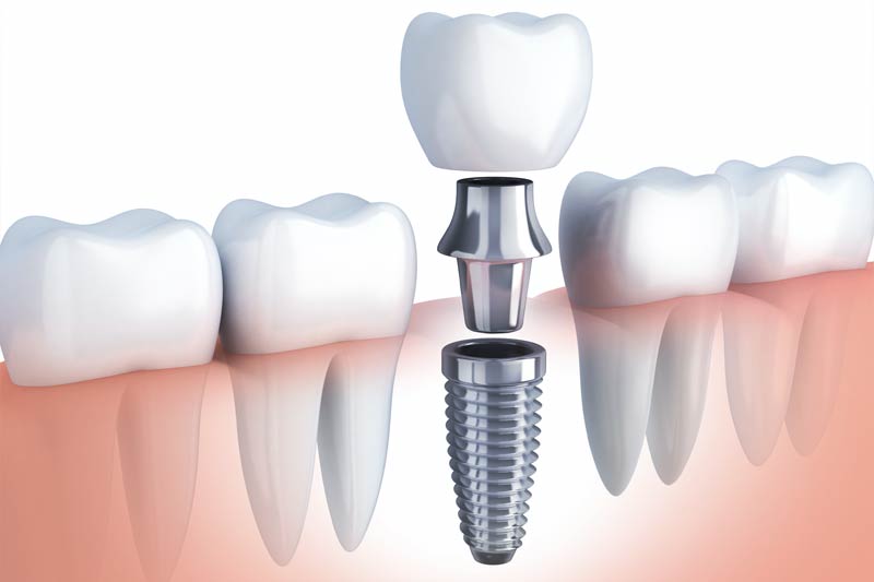 Implants Dentist in Boerne