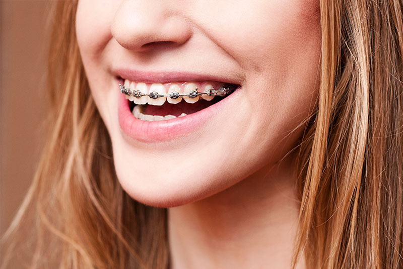 Orthodontics in Boerne