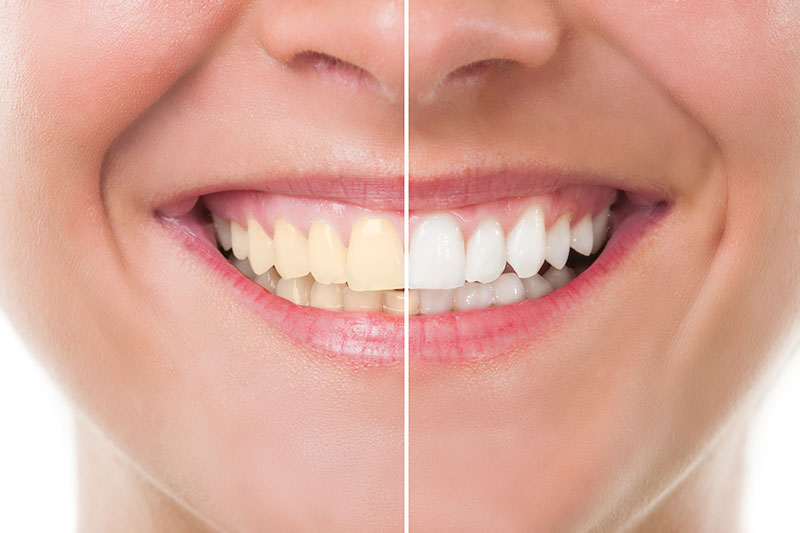 Teeth Whitening in Boerne