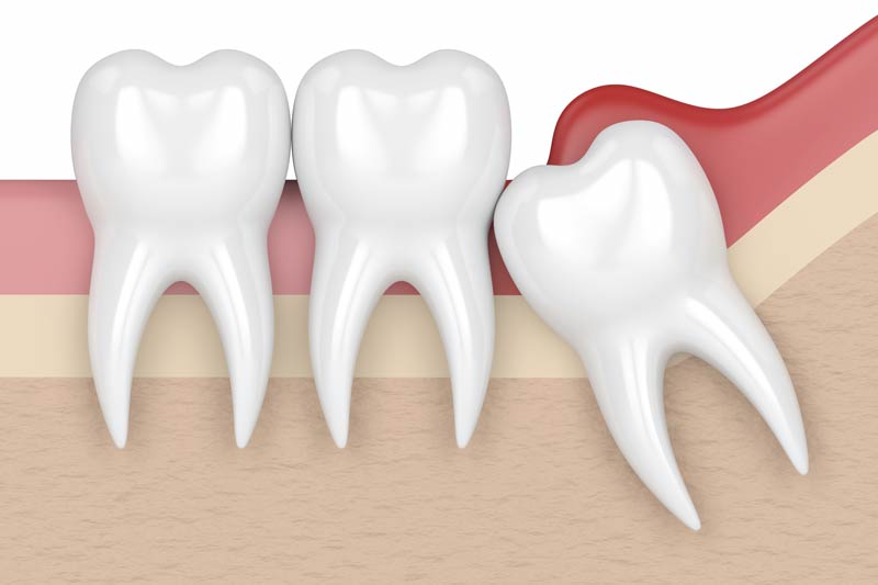 Wisdom Tooth Removal in Boerne